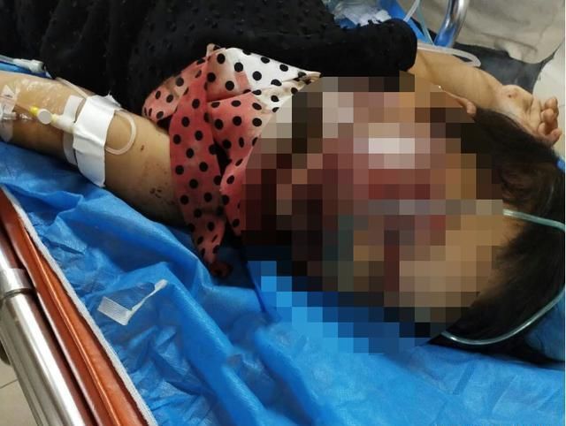  重伤|男子用铁锹疯狂击打祖孙俩 致一死一重伤 警方：嫌疑人已自尽