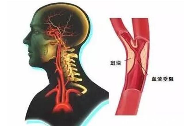 常会|脑供血不足的人，身体常会出现3个症状，当心血管堵塞