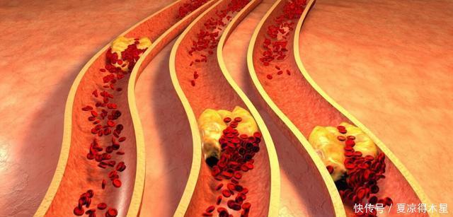  堵住|3道家常菜堪称“堵血王”，吃得越欢，血管越“堵”，趁早管住嘴