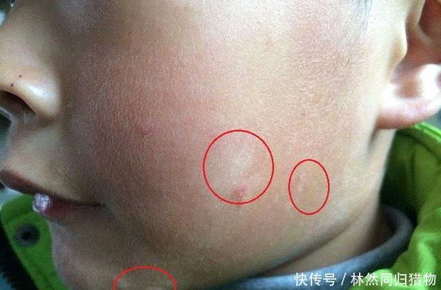 特征|孩子出现这两个特征,说明已经营养不良,妈妈多留意