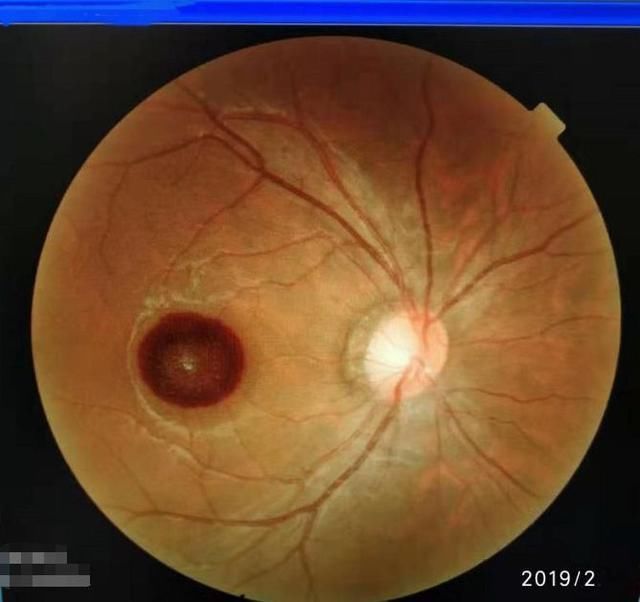 大喊|大伯捡回一支笔给7岁外孙玩,孩子突然大喊:我看不见了!医生叹惜:这辈子都恢复不了