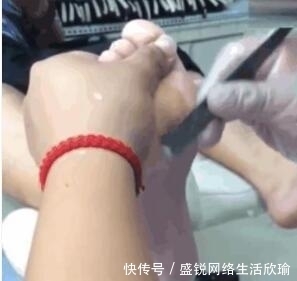  女子|女子3年没洗脚，出嫁前父母带去修脚，刮下来的死皮竟有1厘米厚