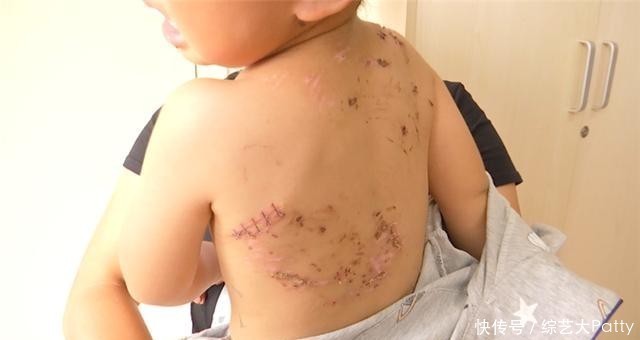 男孩|被狗咬伤的织金男孩出院回家了!还需第二次修复手术