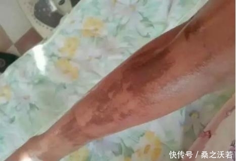 手臂|农村男子手臂意外烧伤,媳妇用鱼皮包裹,结果却让人惊喜