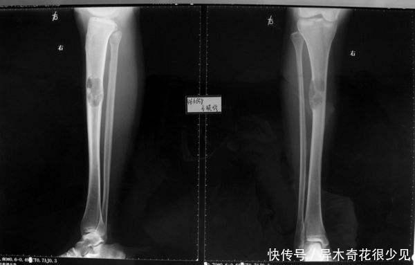 肿物|胳膊上有一个肿物,一碰还会痛有可能是骨肿瘤