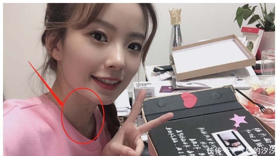 亲爱|《亲爱的自己》:林玲的扮演者陈卓璇,毫不掩饰的胎记是认真的吗