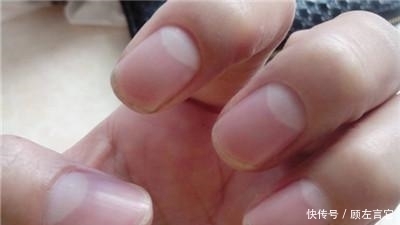 养肝护肝|“肝净”的人,手上一般会有3个“信号”,对照一下,你有几个