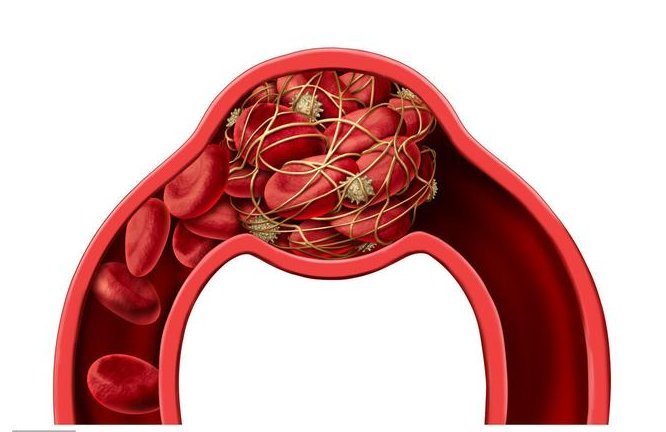 复发|脑梗不到1年就复发，如何预防？坚持做好3件事，养血管保健康