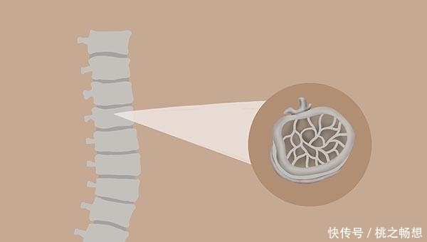  女性|为什么女性45岁后，容易得骨质疏松？吃什么能补钙？