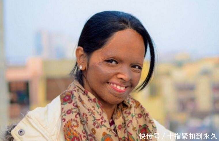 毁容|女孩17岁时因拒绝求婚，被32岁男子泼硫酸毁容